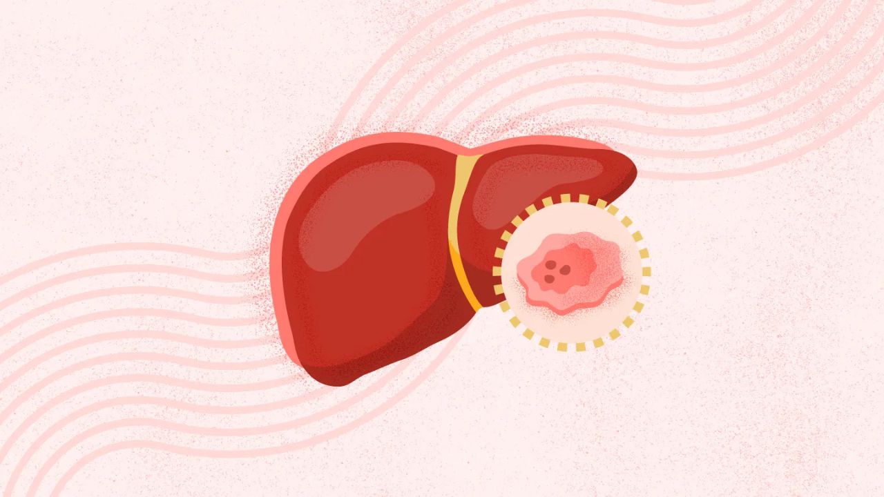 Liver Tumors: सिर्फ पेट दर्द या लीवर ट्यूमर! नजरअंदाज किया तो हो सकता है जानलेवा जानिए इलाज के रास्ते