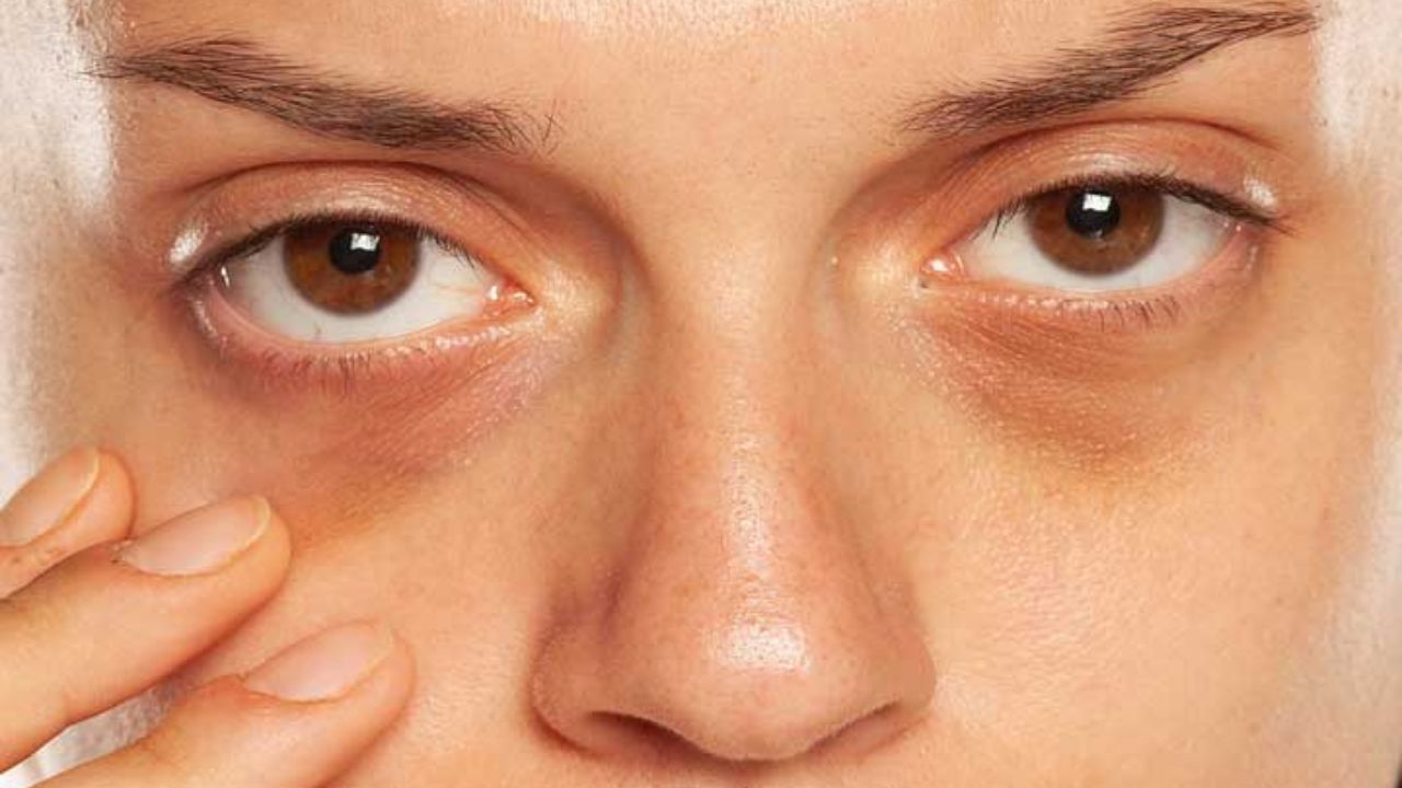 Dark circles: चेहरे की खूबसूरती छीनने वाले काले घेरे कहीं किसी गंभीर बीमारी का इशारा तो नहीं! जानिए क्यों है ये खतरनाक 