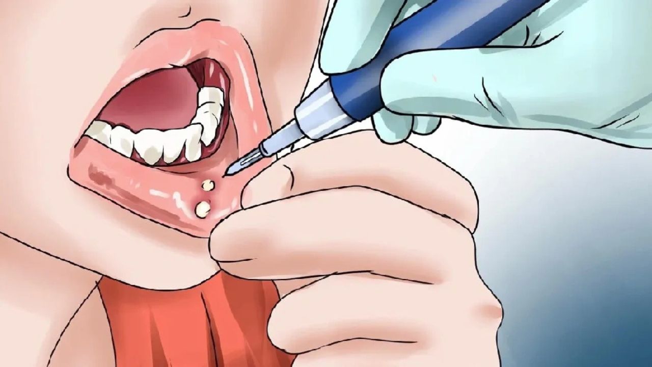 Mouth Ulcers: छोटे दिखने वाले ये छाले बन सकते हैं बड़ी बीमारी का संकेत! आयुर्वेद ने बताया सच