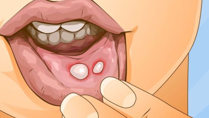Mouth Ulcers: छोटे दिखने वाले ये छाले बन सकते हैं बड़ी बीमारी का संकेत! आयुर्वेद ने बताया सच